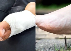 Việc cần làm ngay lập tức nếu giẫm phải vật nhọn
