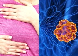 5 bí quyết giúp bạn chủ động phòng ngừa ung thư vú
