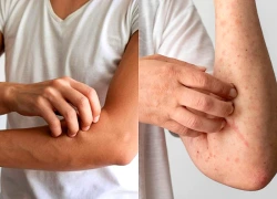 6 dấu hiệu trên da có thể cảnh báo thận đang gặp vấn đề