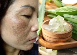 Mách bạn 4 cách trị nám lâu năm từ thiên nhiên, rẻ tiền nhưng cực nhạy