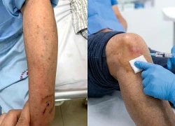 Suy tuyến thượng thận cấp do thuốc: Cấp cứu nội tiết đe dọa tính mạng