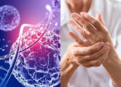 Thử nghiệm liệu pháp tế bào gốc mới điều trị bệnh Parkinson