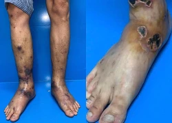 Cứu chữa thành công ca bệnh viêm mạch EGPA cực hiếm tại Việt Nam