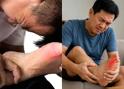 Người mắc bệnh gout chạy bộ thế nào để tránh tái phát?