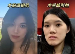 Nữ người mẫu 24 tuổi phẫu thuật thẩm mỹ từ bị móm nhẹ thành mặt lưỡi cày: Lời giải thích của bác sĩ gây phẫn nộ
