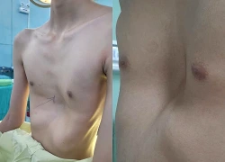 4 dấu hiệu phát hiện lõm ngực bẩm sinh ở trẻ