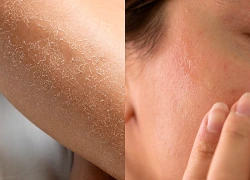 Bệnh hiếm khiến làn da liên tục bong tróc suốt đời