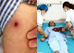 Bệnh nhân nguy kịch vì vết đốt không đau, không ngứa
