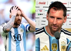 Messi sưng u đầu ‘một cục to”, thắng thì vui mà cái trán thì không, MXH cười hả hê