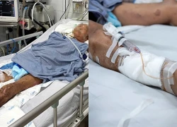 Vết trầy nhỏ khiến người đàn ông tiên lượng rất cao không qua khỏi