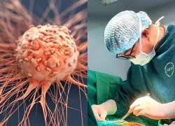 Chuẩn bị mổ ung thư gan, bất ngờ phát hiện thêm ung thư thực quản