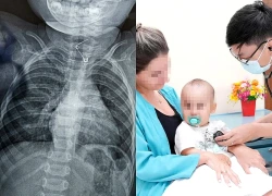 Gắp kim băng khỏi thực quản bé 9 tháng tuổi