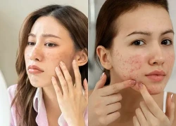 Muốn ngăn mụn tái phát? Đừng bỏ qua 6 bước chăm sóc da quan trọng này