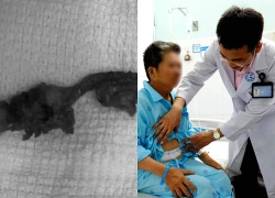 Người đàn ông 54 tuổi đau bụng dữ dội, bác sĩ gắp ra thứ "đáng sợ" trong dạ dày