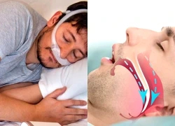 Ngáy to bị vợ giục đi khám, phát hiện căn bệnh có thể dẫn đến đột quỵ