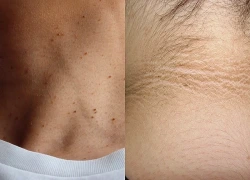 Dấu hiệu ngầm cảnh báo kháng insulin nhiều người dễ bỏ qua