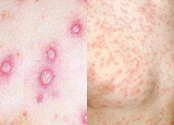 Dấu hiệu nhận biết sớm 5 bệnh truyền nhiễm thường gặp trong mùa mưa
