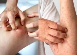 Bỏ qua dấu hiệu, người đàn ông phát hiện ung thư giai đoạn cuối