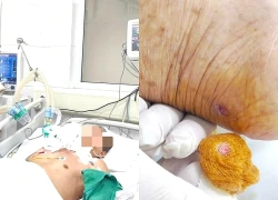 Ngỡ vết thương nhỏ không đáng kể, hai bệnh nhân bất ngờ nguy kịch