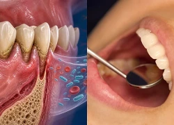 Vi khuẩn thường gặp trong miệng có thể là 'thủ phạm' âm thầm gây hẹp van tim?