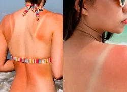 Da cháy nắng sau chuyến đi biển? 5 cách đơn giản giúp làm dịu và phục hồi làn da nhanh hơn