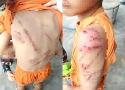 Bé trai 9 tuổi nhập viện với nhiều vết bầm tím, cha đến Công an tự thú
