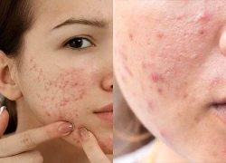 Da dầu mãi không hết mụn? Có thể bạn đang lặp lại 4 thói quen này mỗi ngày