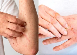 6 thói quen giúp kiểm soát viêm da cơ địa, giảm nguy cơ tái phát