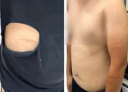 Nam thanh niên tự xé áo, gây thương tích rồi hoang báo bị cướp tiền