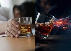 Tác hại của lạm dụng rượu bia đối với các bệnh mạn tính