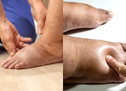 Phù chân khi nào lành tính, khi nào cảnh báo bệnh lý nguy hiểm?