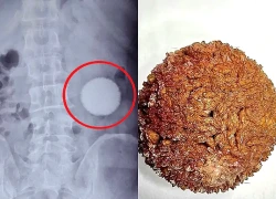 Đau bụng 20 năm trời, người đàn ông sốc khi bác sĩ gắp ra thứ "đáng sợ" trong bụng