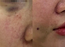 Cô gái bị tắc mạch, hoại tử sau khi tiêm filler làm đầy rãnh cười ở spa