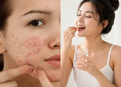Bổ sung collagen có bị nổi mụn?