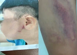 Điều tra vụ bé trai 9 tuổi nghi bị cha ruột bạo hành ở TPHCM