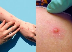 Bùng phát đợt dịch bệnh đậu mùa khỉ đầu tiên ở Guinea-Bissau