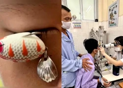 Lưỡi câu xuyên thủng giác mạc bé trai 13 tuổi, cảnh báo tai nạn trước thềm năm học mới