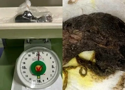 Phẫu thuật lấy khối tóc lớn trong bụng bé gái 5 tuổi