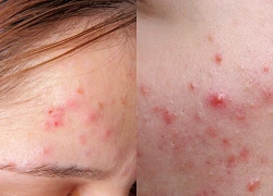 5 cách chăm sóc da và hạn chế trứng cá đỏ tái phát
