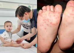 Trẻ đã từng mắc tay chân miệng vẫn có thể mắc lại