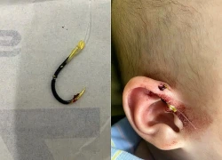 Lưỡi câu móc vào vành tai bé 10 tháng tuổi