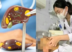 Men gan tăng 30 lần sau hơn 1 tháng uống thuốc bắc chữa bệnh