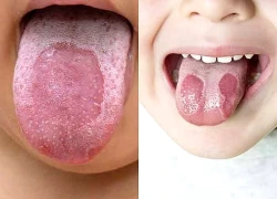 Những yếu tố làm tăng nguy cơ mắc lưỡi bản đồ
