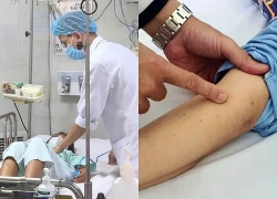 Tiếp xúc gần bệnh nhân não mô cầu, ai cần uống thuốc dự phòng?