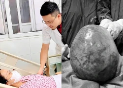 Tưởng tăng cân khi bụng to, người phụ nữ bất ngờ với khối u xơ tử cung nặng 6kg