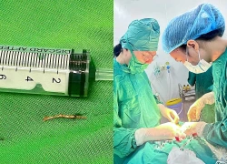 Mắc xương cá, người đàn ông phải cắt bỏ tuyến dưới hàm