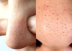 Mụn đầu đen mãi không hết? Có thể bạn vẫn đang mắc 5 thói quen này mỗi ngày