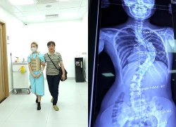 Phẫu thuật thành công cho bệnh nhân bị vẹo cột sống tới 76 độ