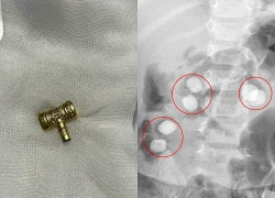 Bác sĩ gắp búa đồ chơi khỏi thực quản bé trai 3 tuổi