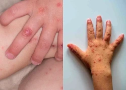 Đừng chủ quan với bệnh tay chân miệng: Thấy 6 biểu hiện này cần đi khám sớm